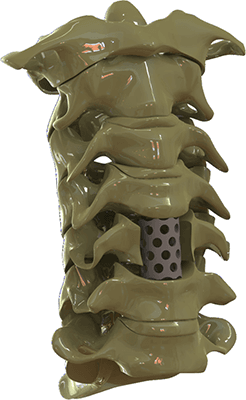 Cage de Corpectomia Cervical Vert System VSII – Mesh OTP
