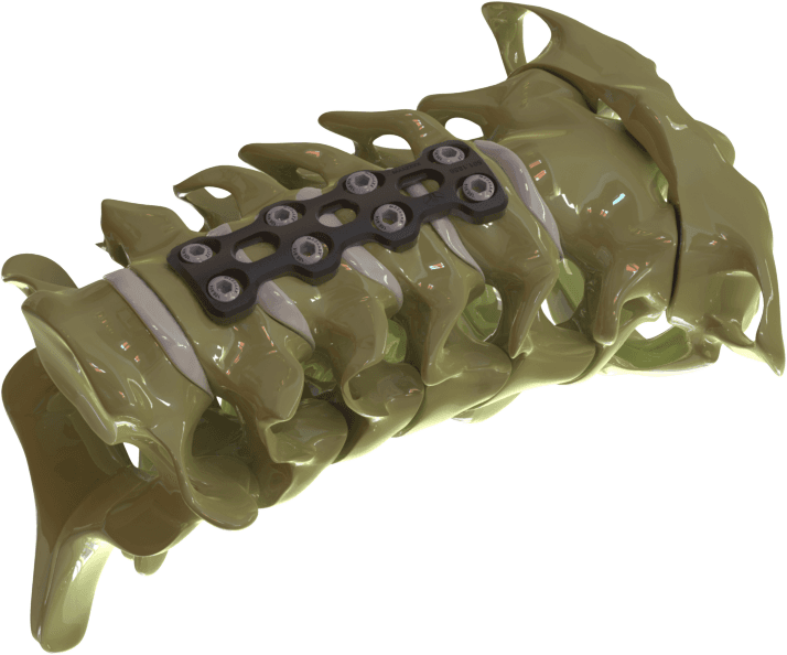 Vert System VSII – Cervical - OTP